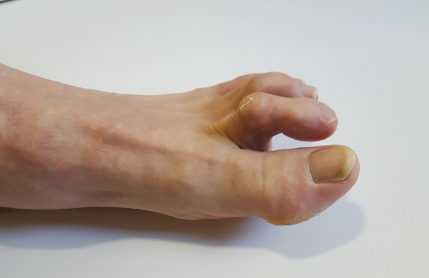 Consejos para prevenir y tratar las durezas en los pies