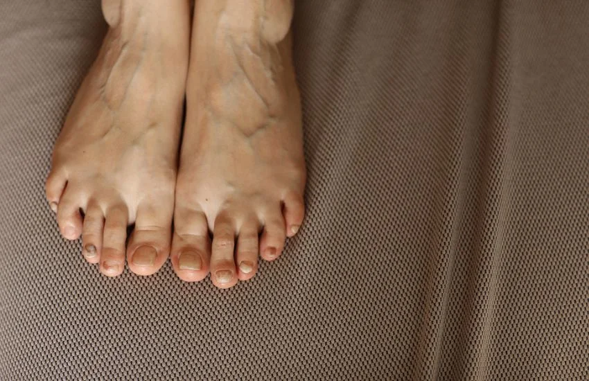 img blog Tratamiento de las unas negras en deportistas Pies descansando sobre una superficie representando las uñas negras en deportistas